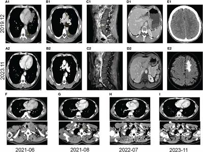 Case report: Clinical complete response in advanced ALK-positive lung squamous cell carcinoma: a case study of successful anti-PD-1 immunotherapy post ALK-TKIs failure